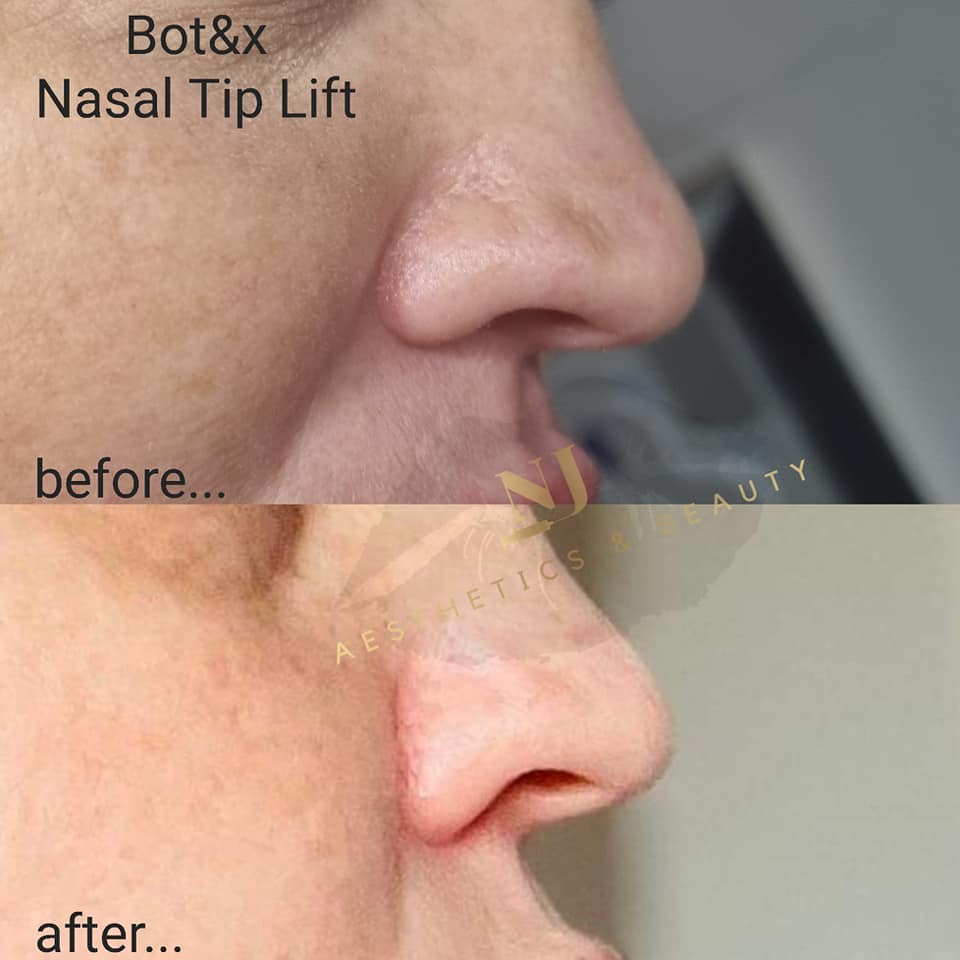 Anti Wrinkle Treatments (Advanced)