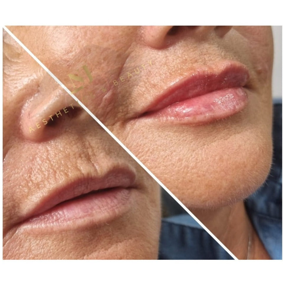 Anti Wrinkle Treatments (Advanced)