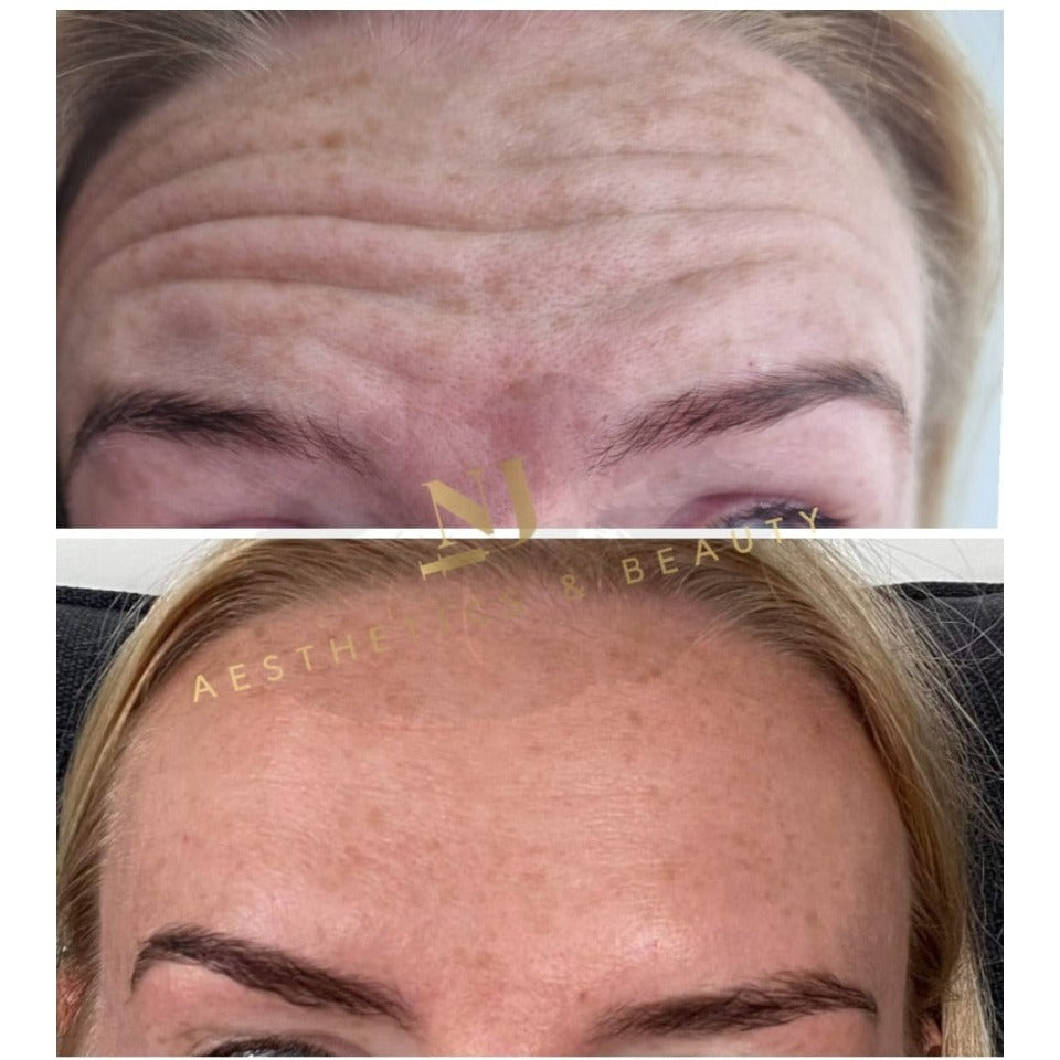 Anti Wrinkle Treatments (Advanced)