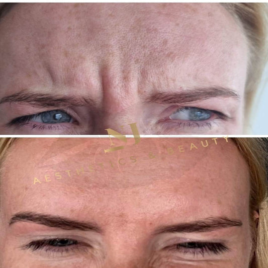 Anti Wrinkle Treatments (Standard)