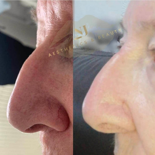 Non-Surgical Rhinoplasty