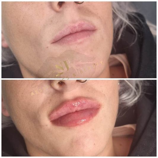 Lip Enhancement