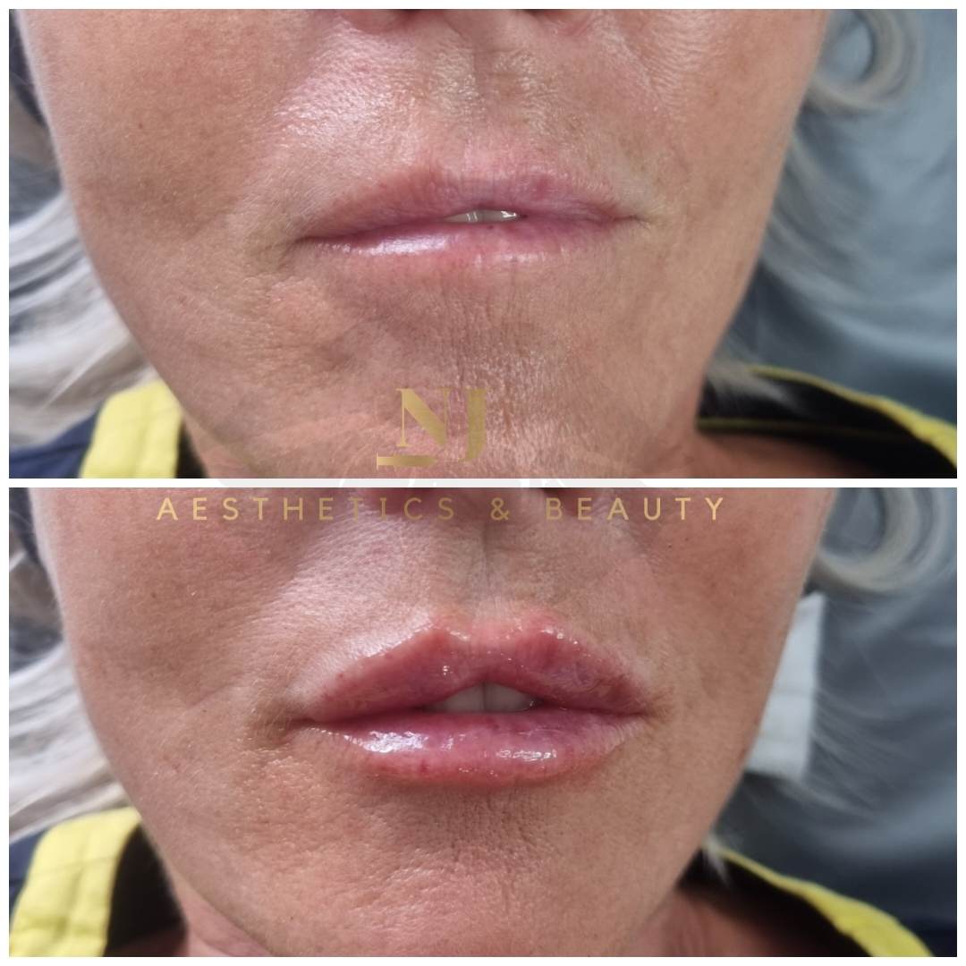 Lip Enhancement