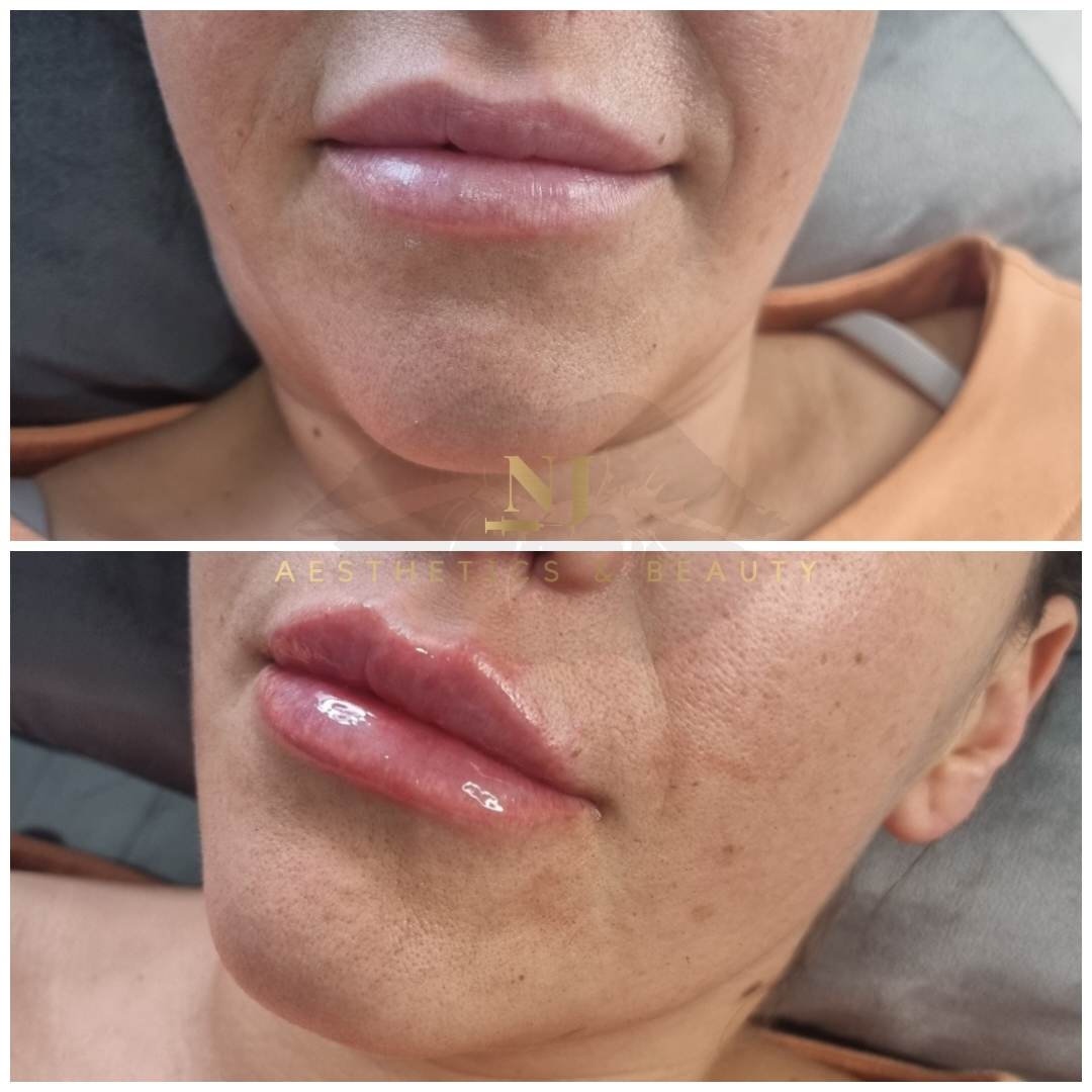 Lip Enhancement