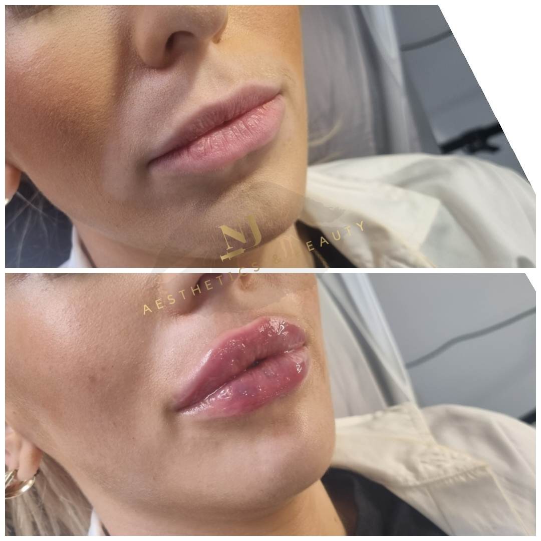 Lip Enhancement