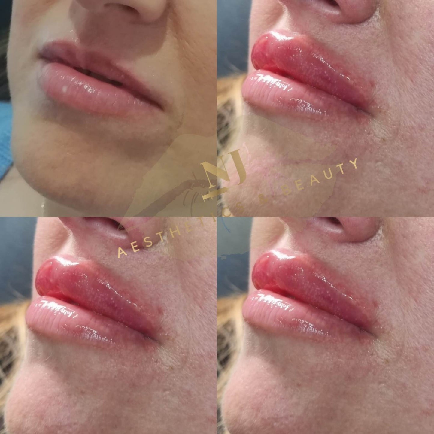 Lip Enhancement