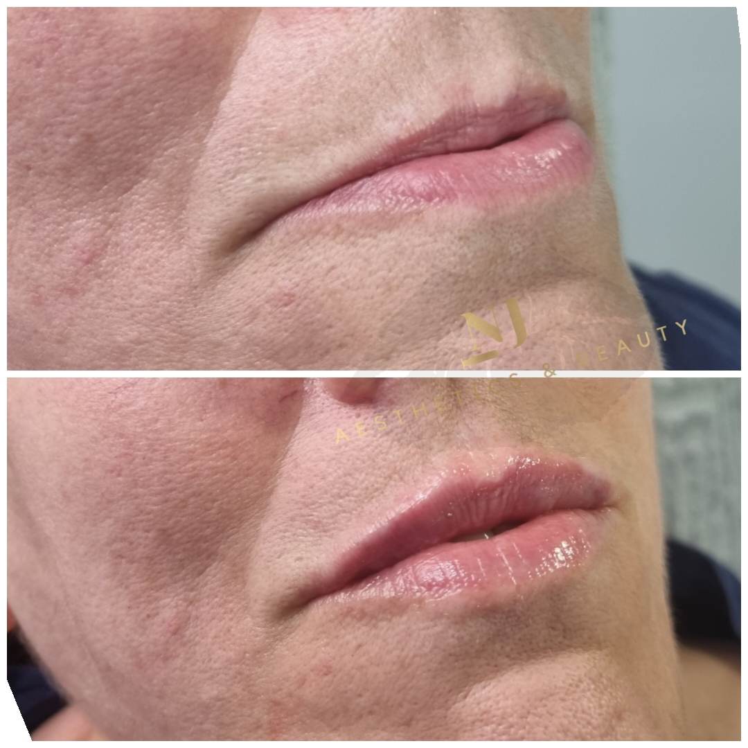 Lip Enhancement